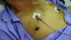 Pecho de hombre al que se le está practicando un electro