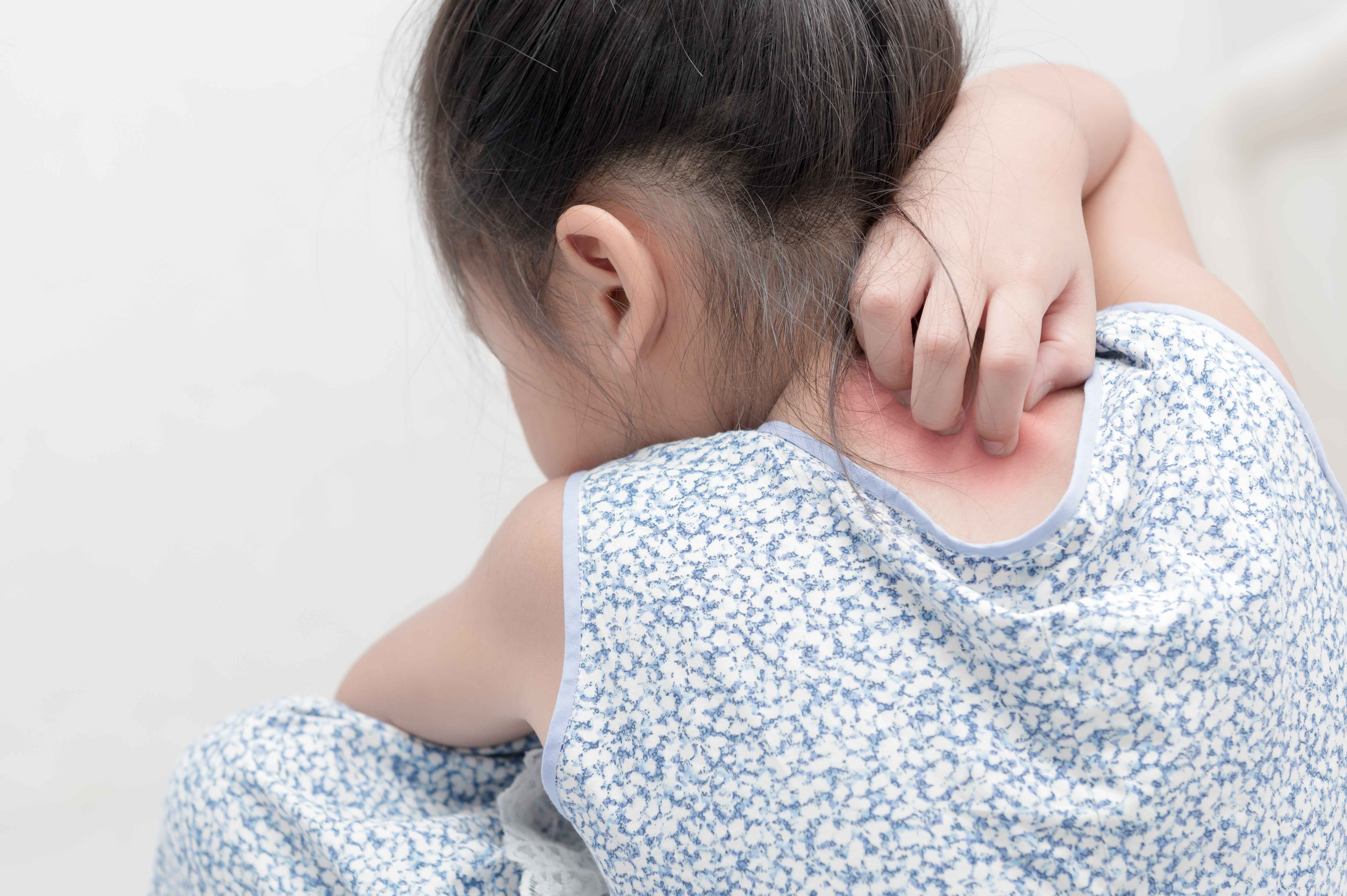 Niña de espaldas rascando sarpullido detrás del cuello